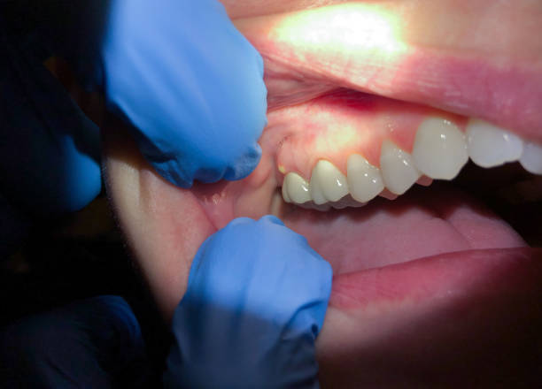 Best Root Canal Emergency Dentist  in Belgium, WI